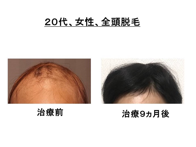 円形脱毛症　病院